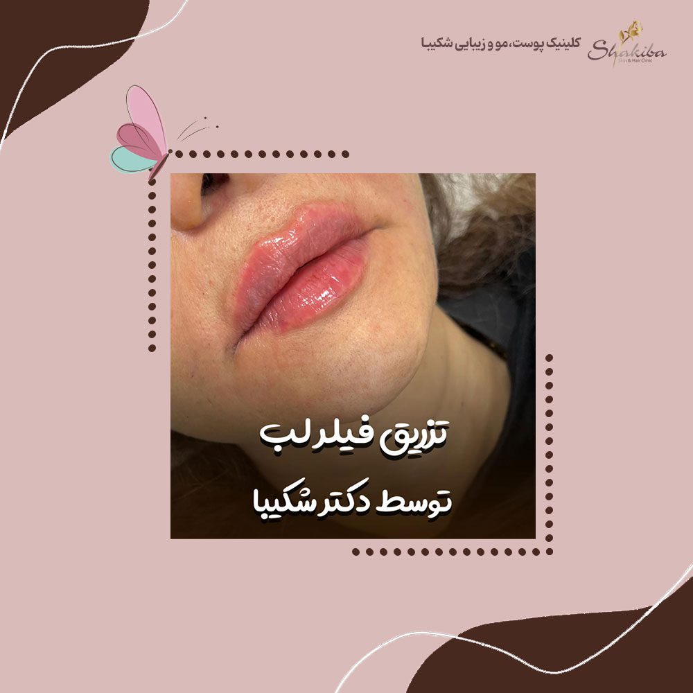 تزریق ژل لب