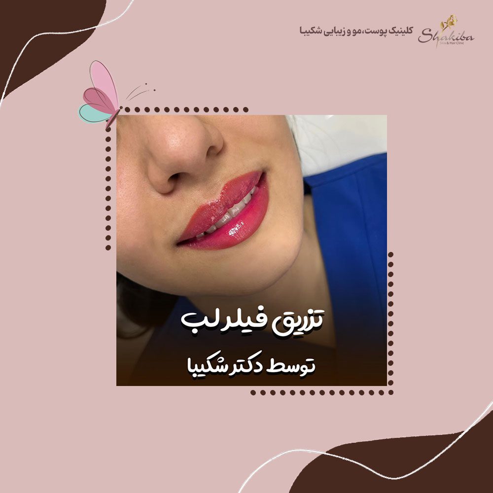 تزریق فیلر لب