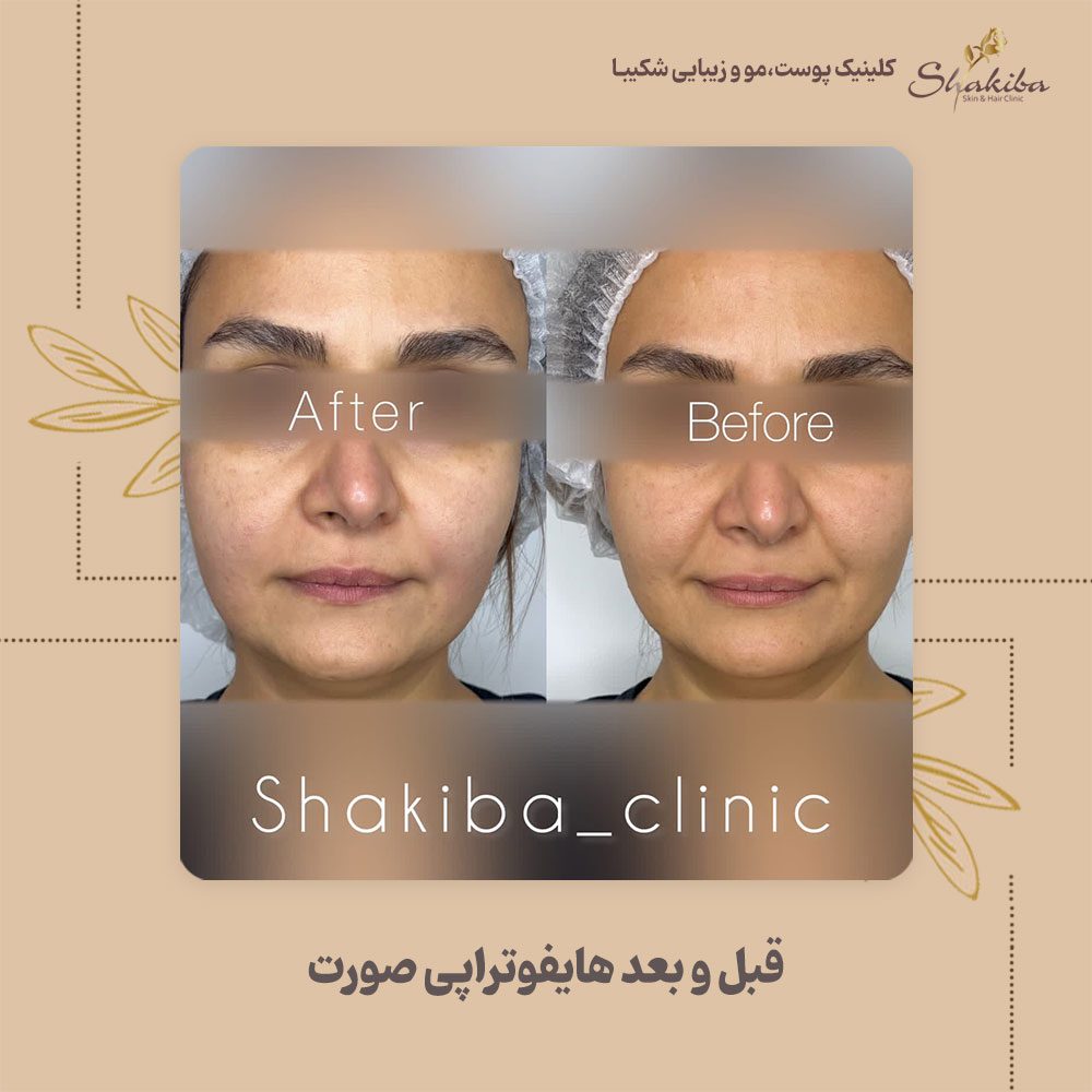 عکس قبل و بعد از هایفوتراپی صورت