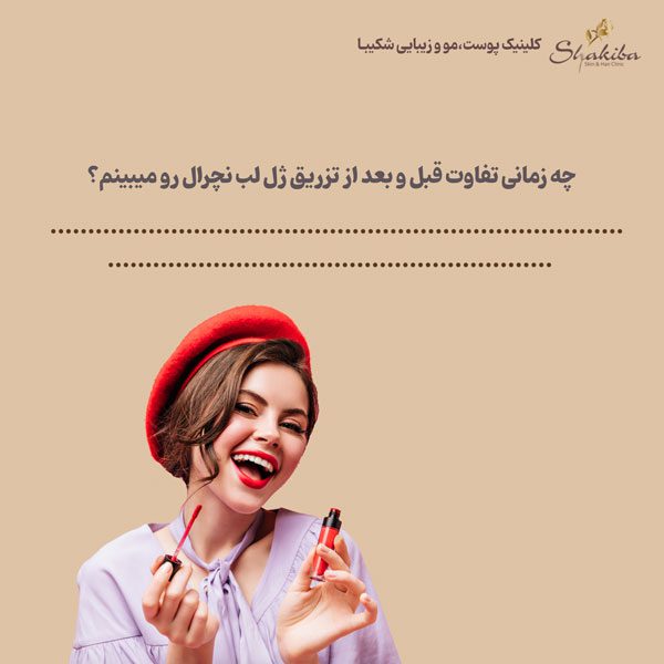 تفاوت قبل و بعد از تزریق ژل لب نچرال