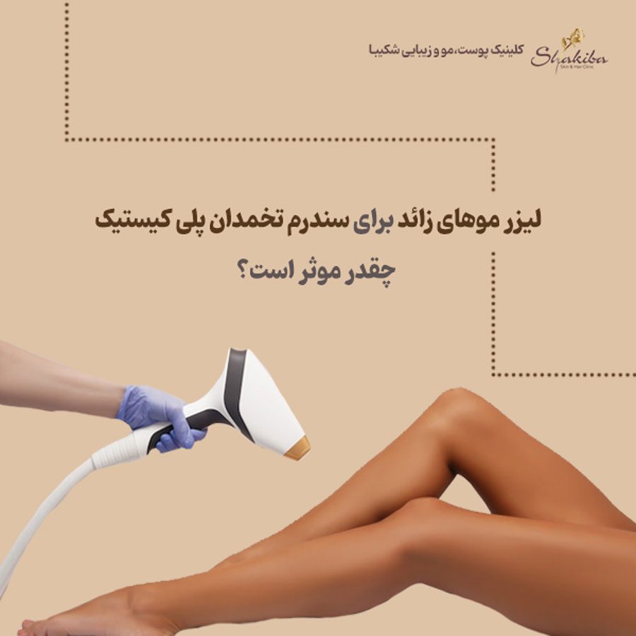 لیزر موهای زائد برای سندرم تخمدان پلی کیستیک