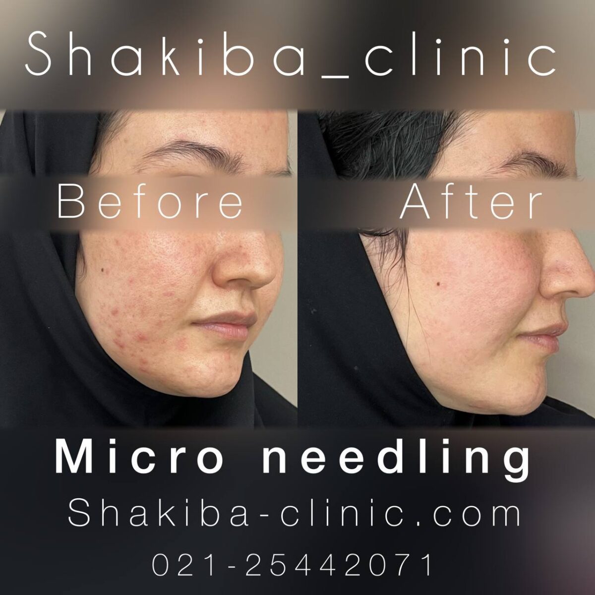 عکس قبل و بعد از میکرونیدلینگ