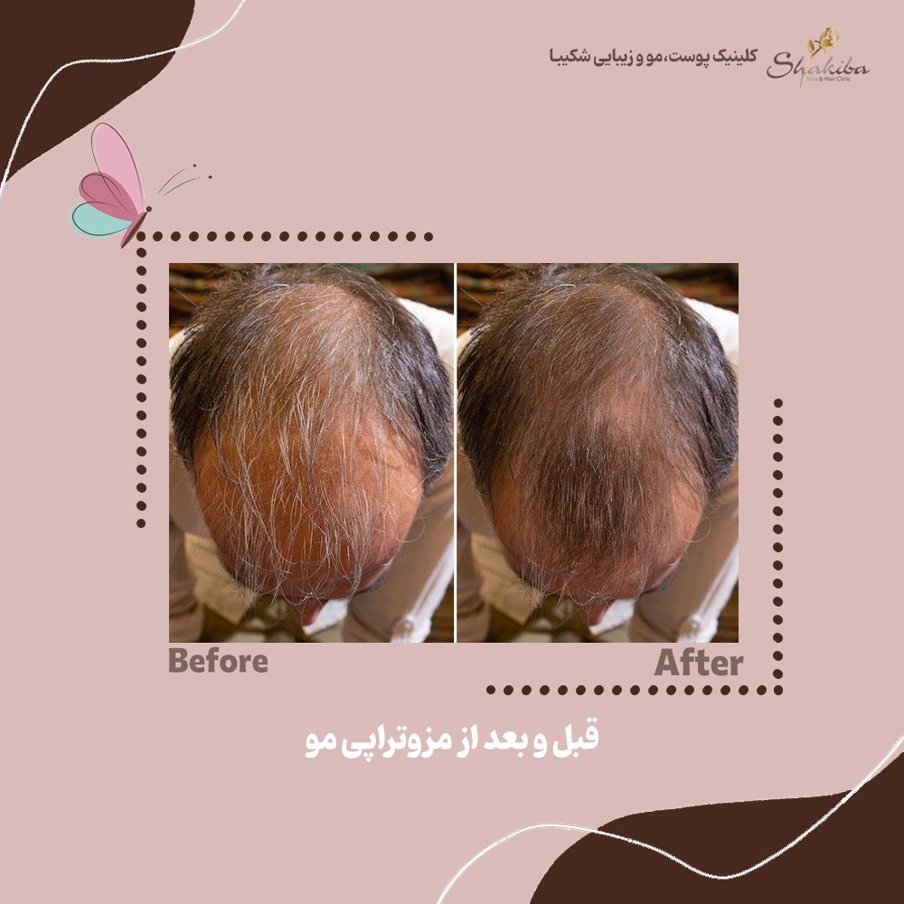 قبل و بعد مزوتراپی مو