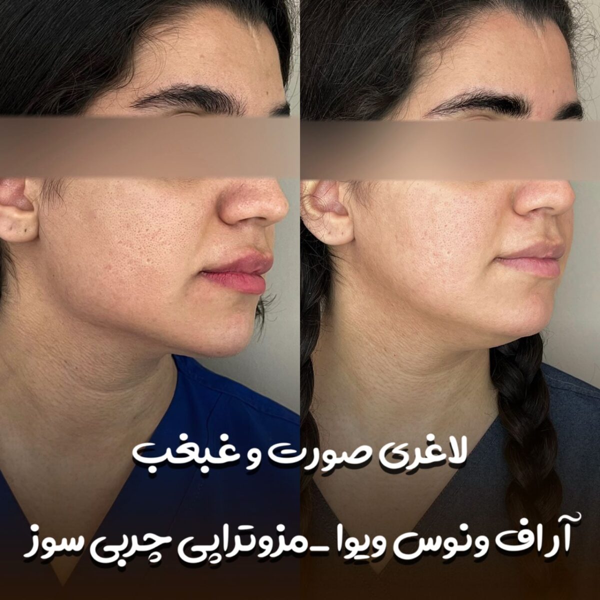 سریعترین راه رفع غبغب