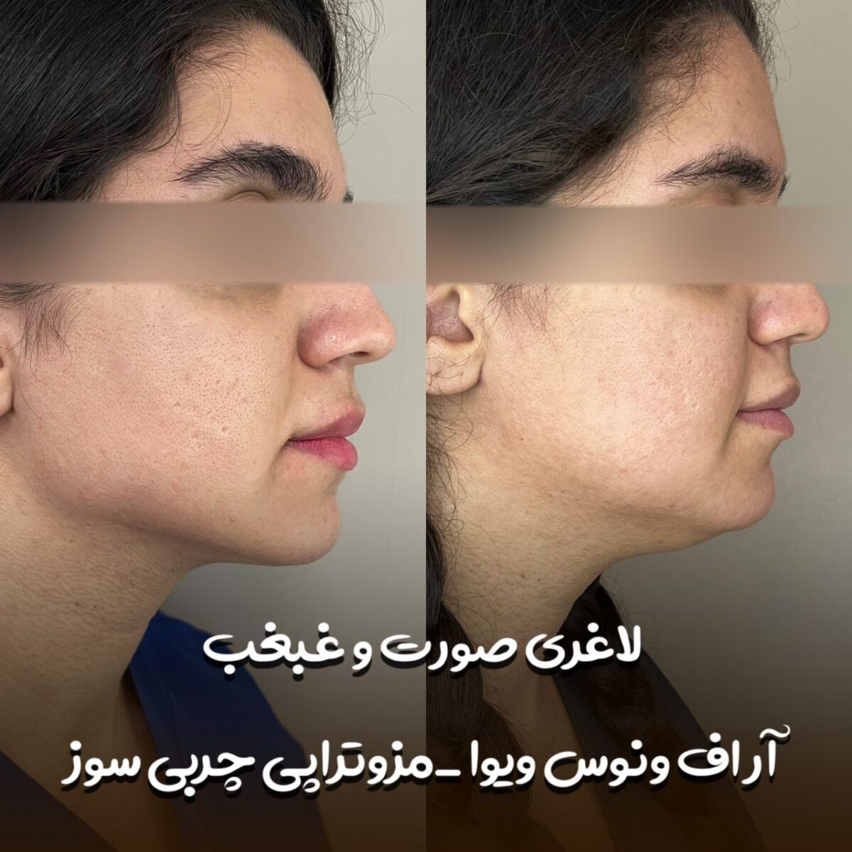 سریعترین راه رفع غبغب