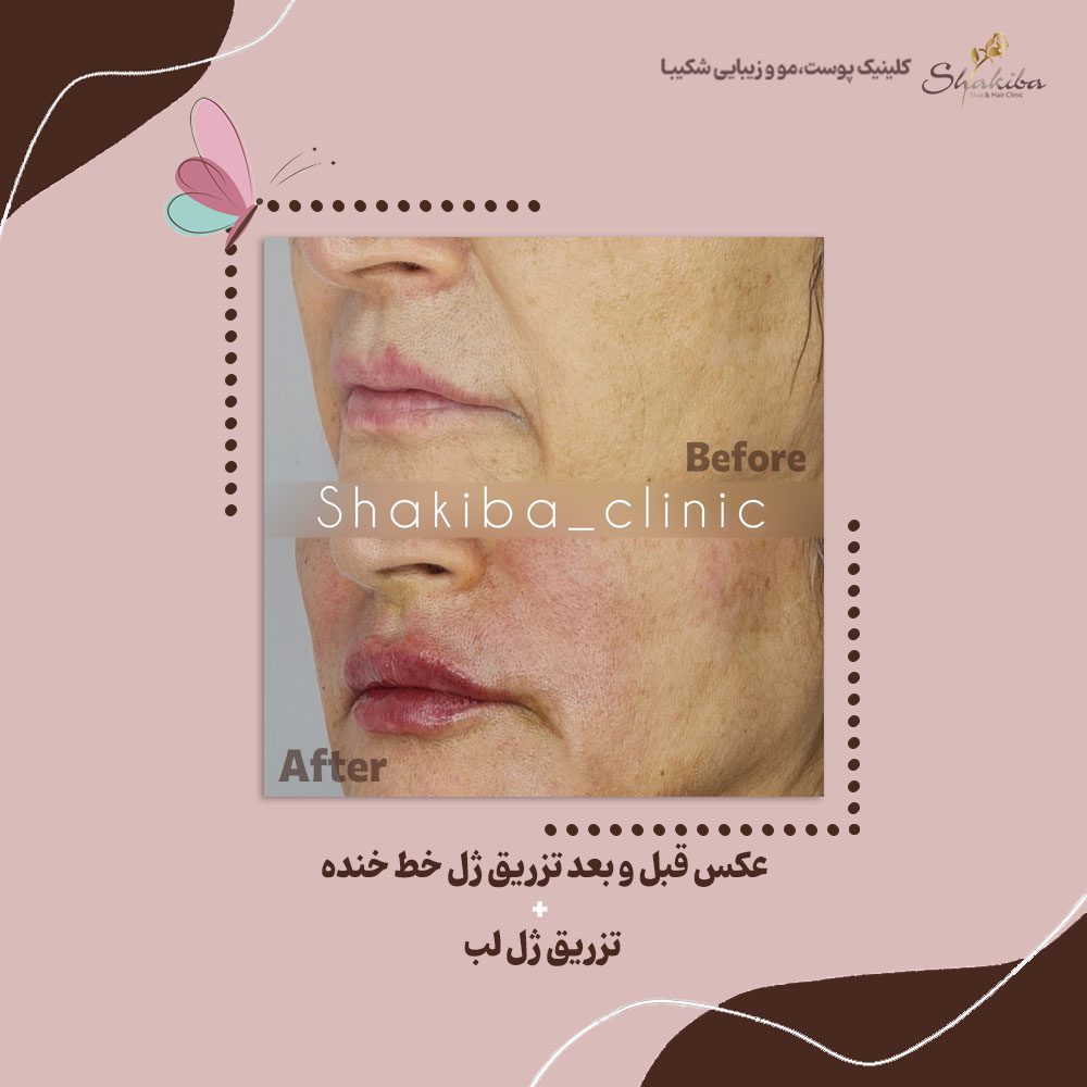 عکس قبل و بعد از تزریق ژل خط خنده
