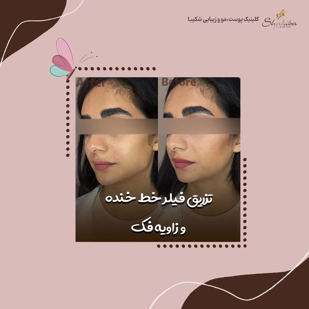 تزریق فیلر خط خنده
