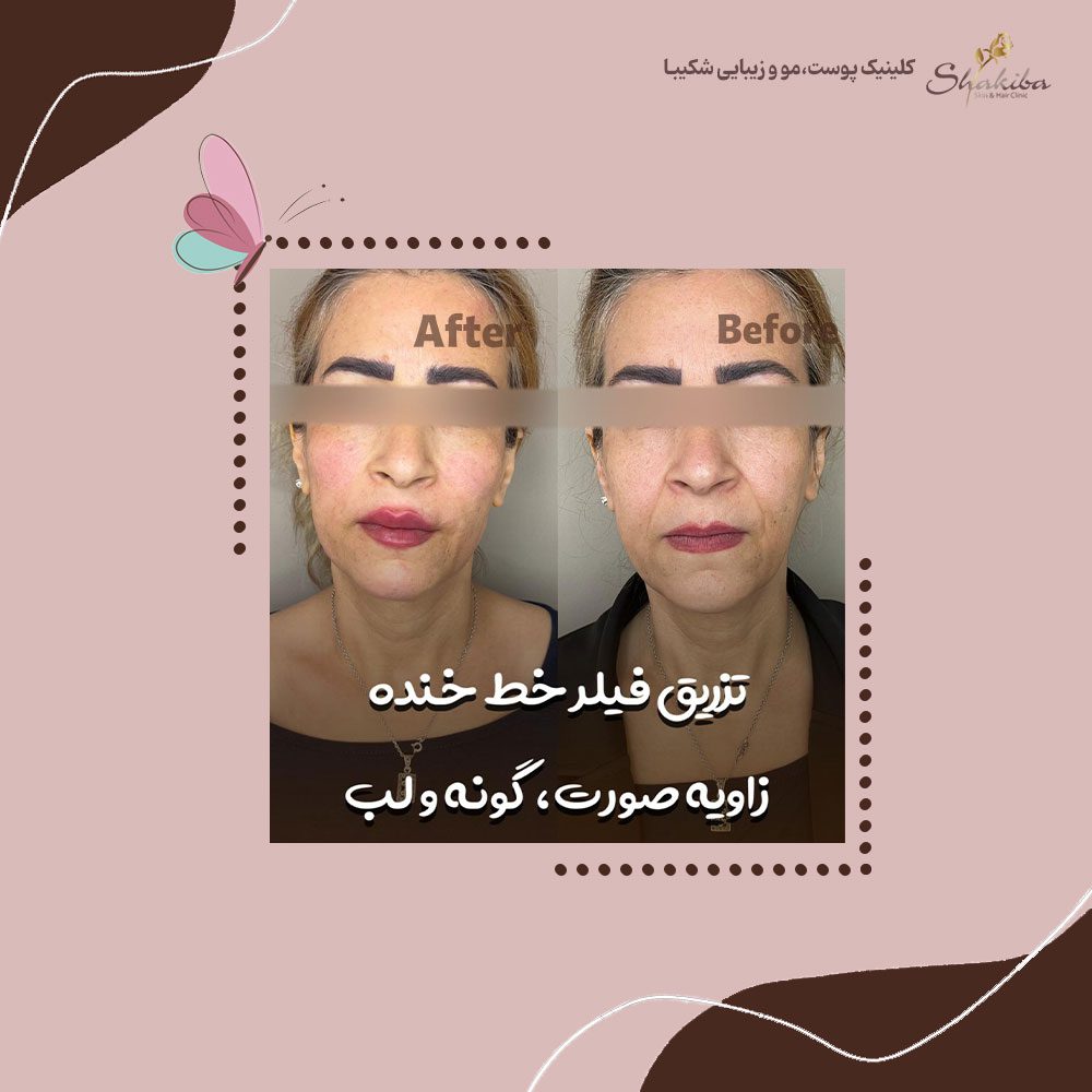تزریق فیلر خط خنده