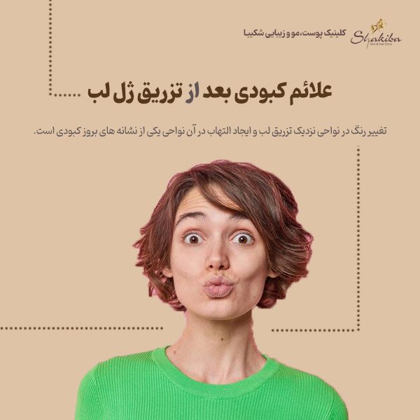 علائم کبودی بعد از تزریق ژل لب