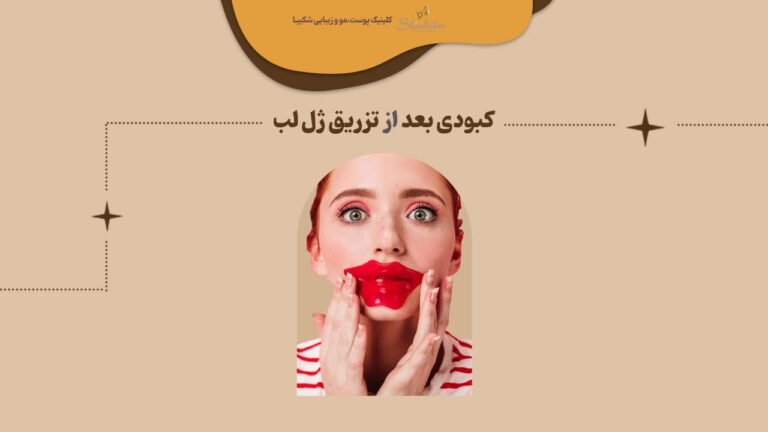 کبودی بعد از تزریق ژل لب