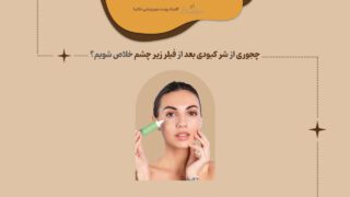 کبودی بعد از فیلر زیر چشم