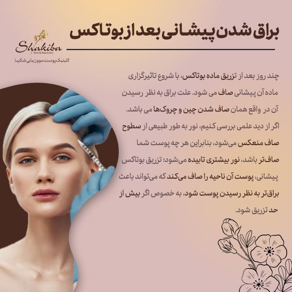 براق شدن پیشانی بعد از بوتاکس