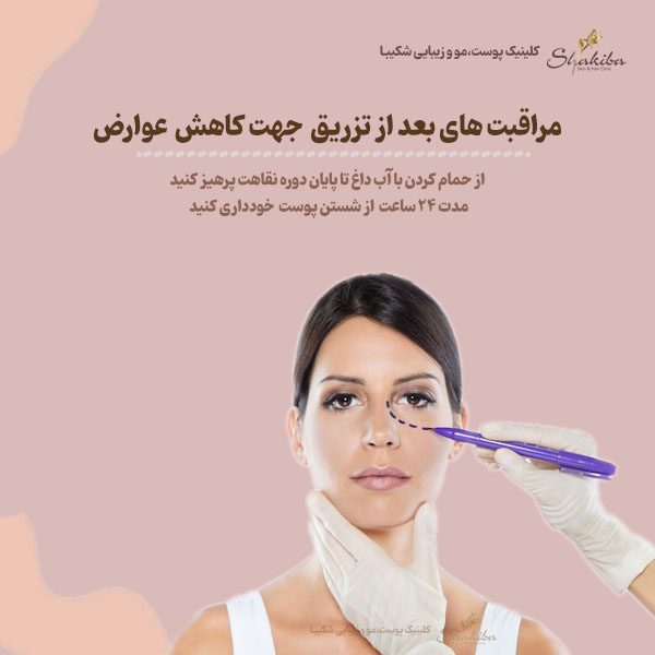 مراقبت های قبل از انجام تزریق جهت کاهش بروز عوارض فیلر زیر چشم