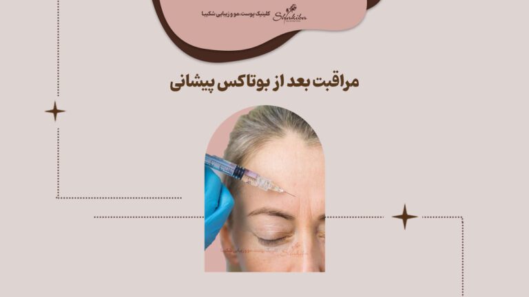 مراقبت بعد از بوتاکس پیشانی