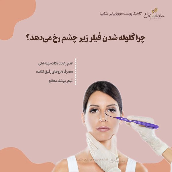 گلوله شدن فیلر زیر چشم 
