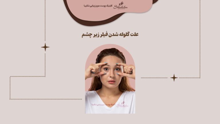 علت گلوله شدن فیلر زیر چشم