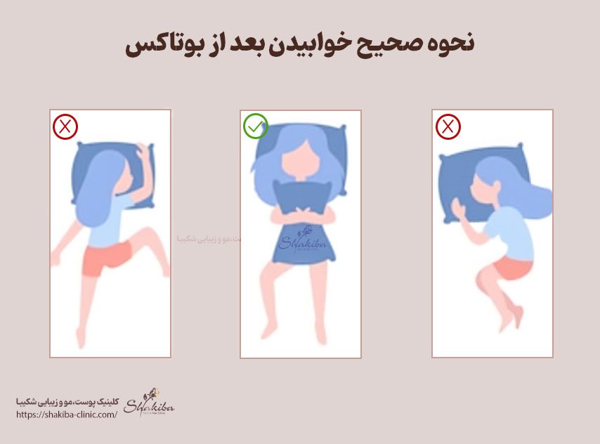 بعد از بوتاکس تا چند ساعت نباید به پهلو خوابید