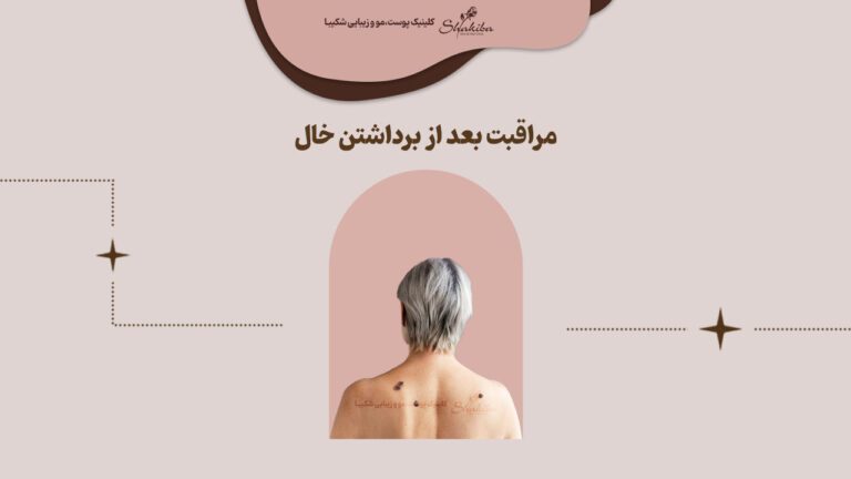 مراقبت بعد از برداشتن خال چیست