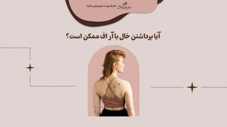 روش برداشتن خال با آر اف