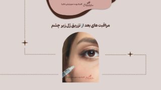 مراقبت های بعد از تزریق ژل زیر چشم