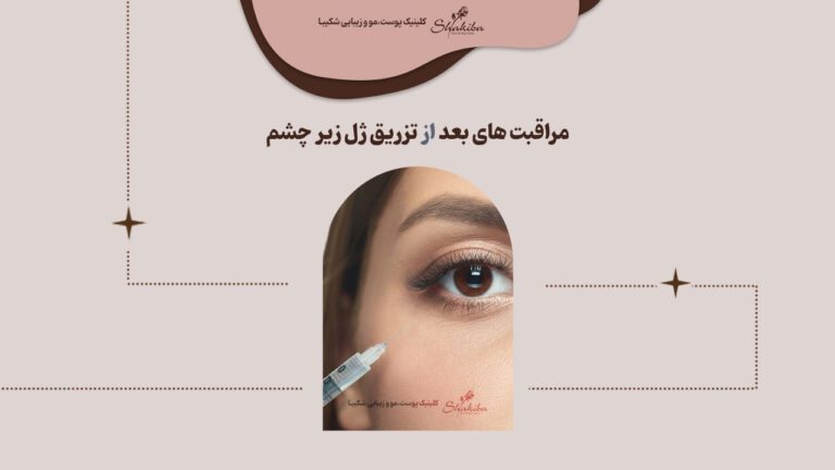 مراقبت های بعد از تزریق ژل زیر چشم