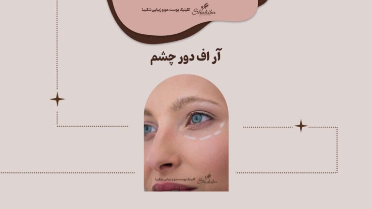 آر اف دور چشم