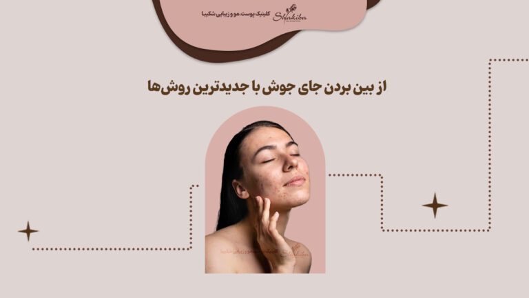 از بین بردن جای جوش با جدیدترین روش‌ها