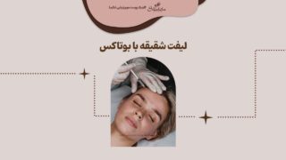 لیفت شقیقه با بوتاکس