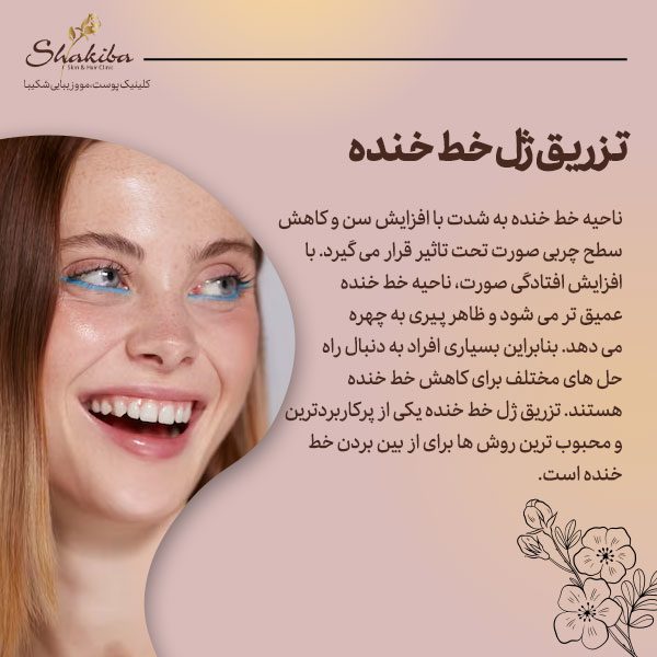 تزریق ژل خط خنده