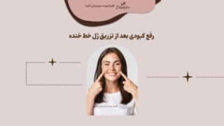روش رفع کبودی بعد از تزریق ژل خط خنده